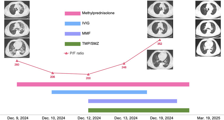 Recurrent Checkpoint Inhibitor-Related Pneumonitis Refractory to Corticosteroid Treatment: A Case Report and Literature Review.