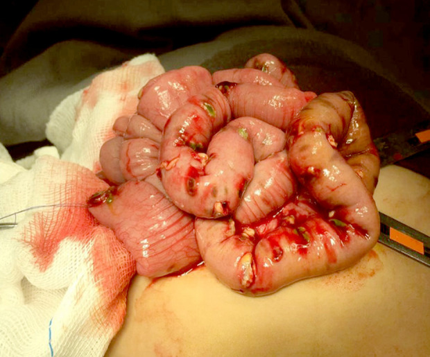 Optimal Closure Timing for Protective Jejunostomy in an Infant with Necrotizing Enterocolitis: A Case Report.