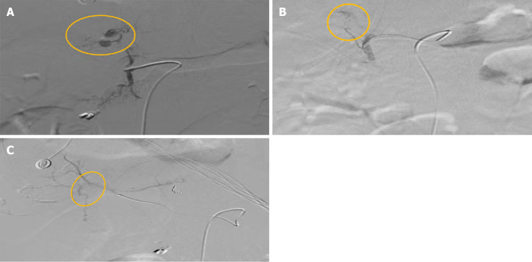 Vascular anomaly as a cause of late bleeding after endoscopic retrograde cholangiopancreatography: A case report.