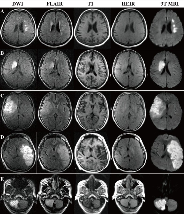 0.23-Tesla MRI to differentiate between ischaemic and haemorrhagic strokes within 24 hours of onset: a combined experimental-clinical study.
