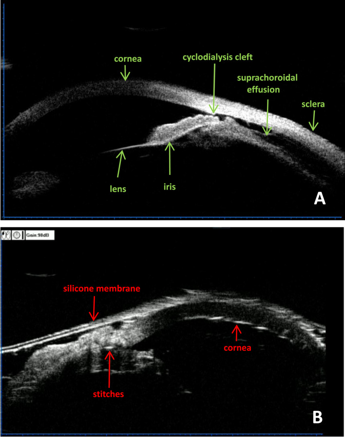 Intraoperative UBM-guided direct cyclopexy for traumatic cyclodialysis cleft: a four-case series.