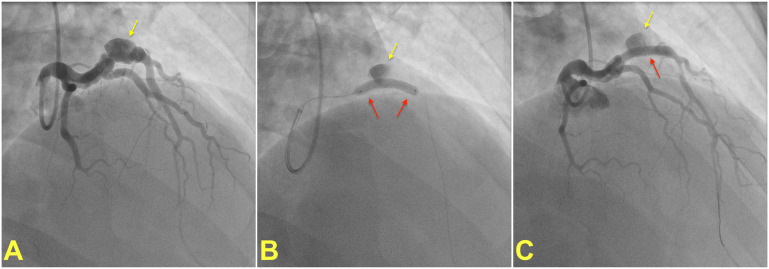 Pathophysiology, Diagnosis, and Management of Coronary Artery Aneurysms: A Review.