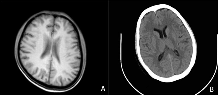 Central nervous system infections in patients with anti-interferon-γ autoantibodies: case series and review of the literature.