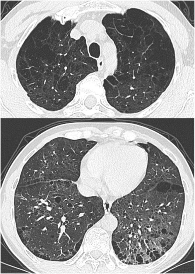 The Dual Threat Combined Pulmonary Fibrosis and Emphysema (CPFE): Two Cases.