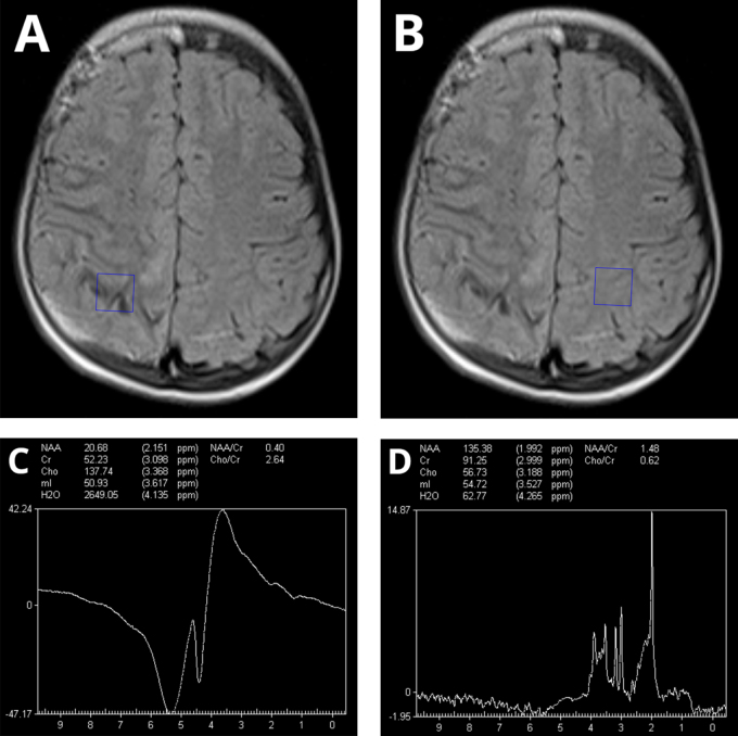 Sturge-Weber syndrome Type I: a rare case report.