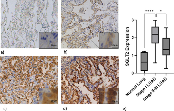 Preclinical Evaluation of Novel SGLT2-Targeted Near-Infrared Optical Imaging Agent for Early-Stage Pulmonary Adenocarcinoma.