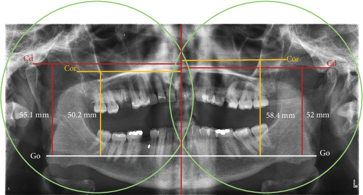 Suspected Posttraumatic Mandibular Coronoid Hyperplasia and Condylar Hypoplasia: Two Case Reports and Literature Review.