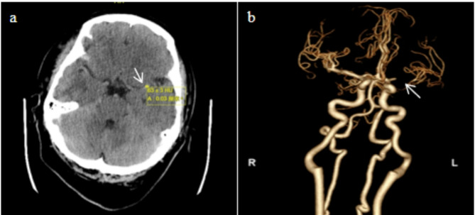 Tirofiban-induced acute profound thrombocytopenia in endovascular therapy for acute ischemic stroke: a rare case report.