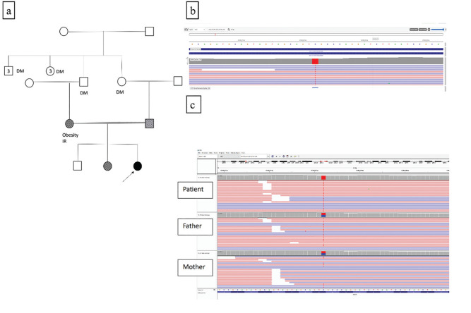 A Rare Case of Monogenic Obesity Due to a Novel Variant in the <i>ADCY3</i> Gene: Challenges in Follow-up and Treatment
