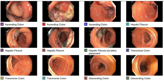 Nonsteroidal Anti-Inflammatory Drug-Induced Granulomatous Colitis: A Case Report and Literature Review of a Vanishing Colonic Mass Mimicking Malignancy.
