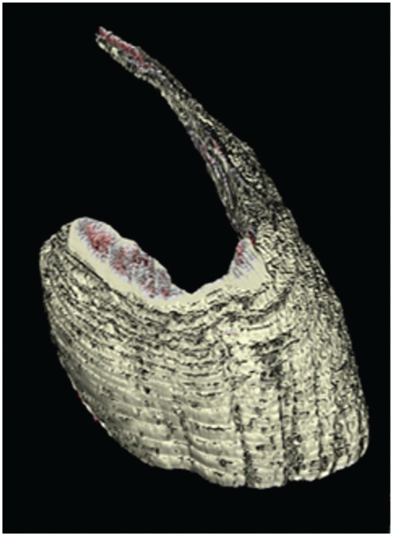 Deltoid Muscle Volume After Superior Capsule Reconstruction in Patients With Irreparable Rotator Cuff Tears: A 3-Dimensional Magnetic Resonance Imaging Analysis.