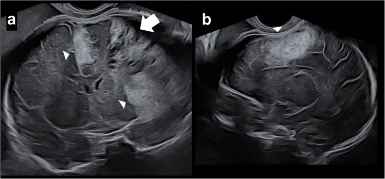 Antenatal subpial hemorrhage diagnosed by fetal magnetic resonance imaging: imaging spectrum and autopsy findings.