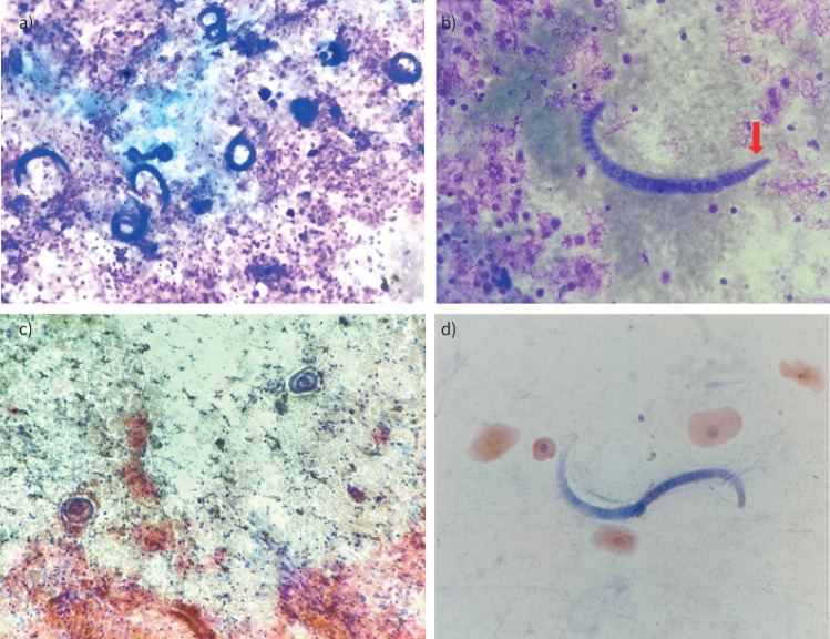 A 53-year-old woman with necrotising myopathy presenting with cough and respiratory distress: a diagnostic conundrum.