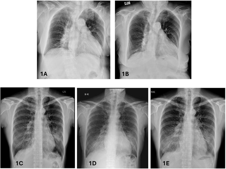 Palivizumab for Severe Respiratory Syncytial Virus Infection in Immunocompetent Adults: A Case Series.