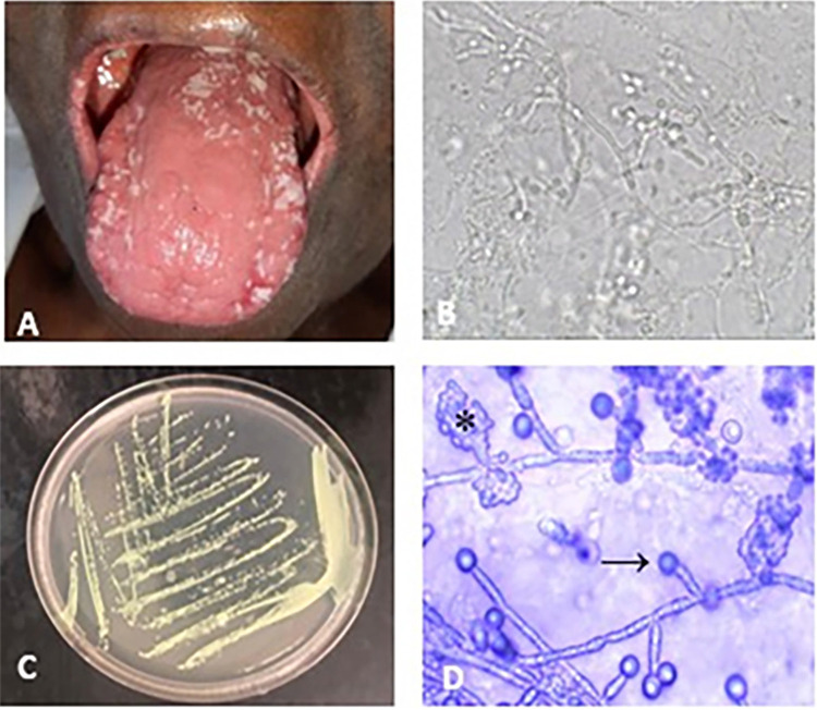 Risk of oral candidiasis: profile analysis of patients admitted to the dermatology clinic of a tertiary hospital in southeast of Brazil.