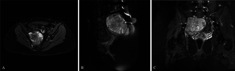 S3 sacral-alar iliac screws application in partial sacral resection for an aneurysmal bone cyst: illustrative case.