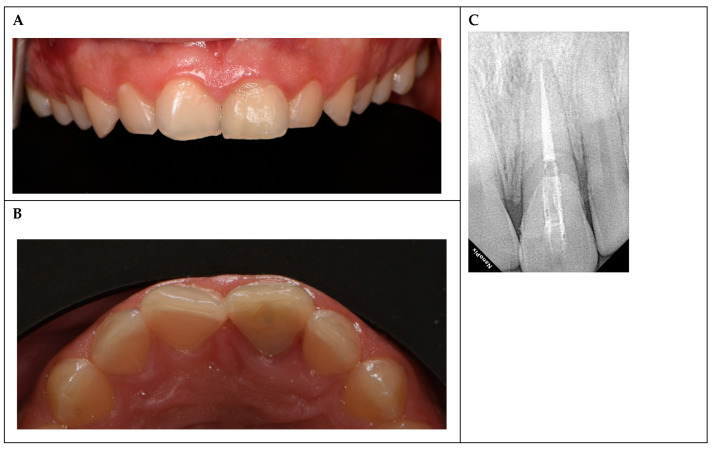 Management of a Complicated Crown Fracture in a 16-Year-Old Patient: A Case Report.
