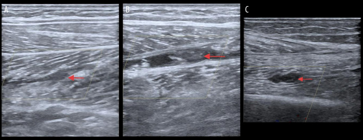 Rapid-Onset Venous Thrombosis After Tibia Fracture: A Case Report.