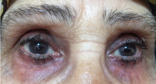 Oculoplastic Challenges in Patients with Glaucoma.