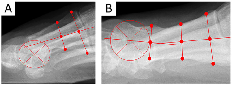 Correction of Severe Hallux Valgus Deformity Using a Percutaneous Metatarsal Distal Osteotomy.