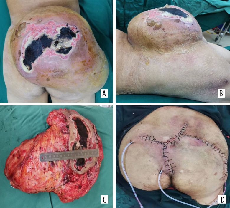Diagnosis and Management of Large Extraosseous Myxoid Chondrosarcoma of the Buttocks: A Case Report.