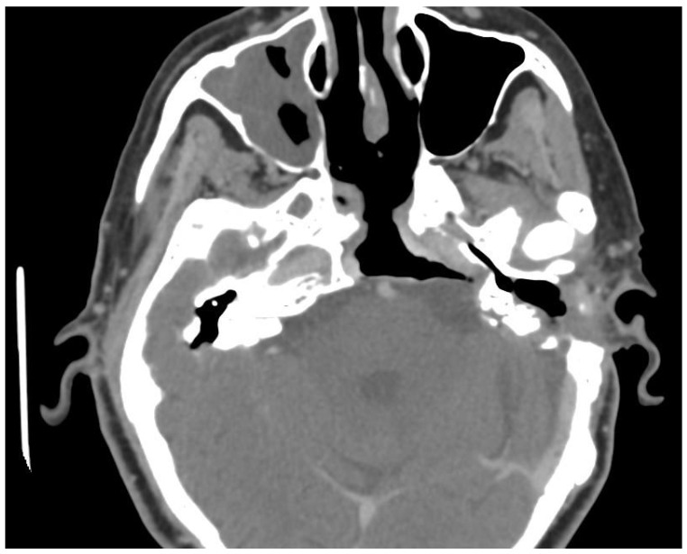 Extensive Cholesteatoma Compromising the Entire Ipsilateral Skull Base: Excision Through a Multi-Corridor Surgical Technique.