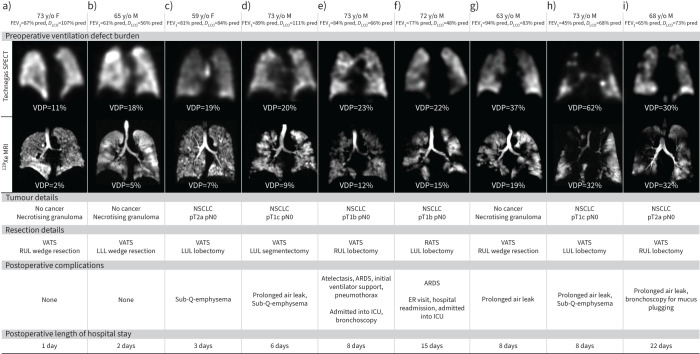 Ventilation defect burden predicts lung cancer resection outcomes.