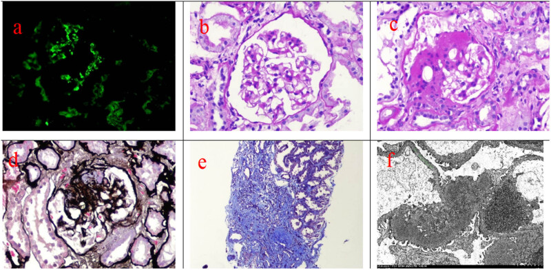 A case of IgA nephropathy treated with a combination of telitacicept and half-dose glucocorticoids.