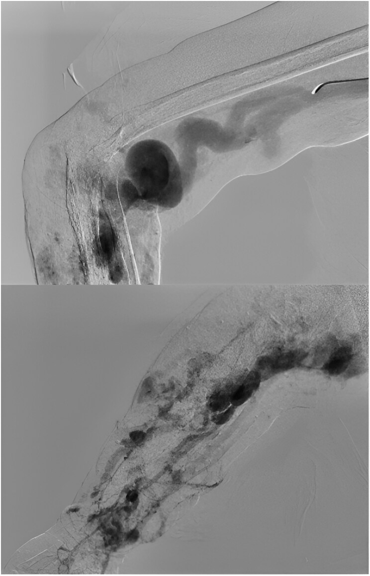 Parkes Weber syndrome, a rare case of pulmonary hypertension: a case report.