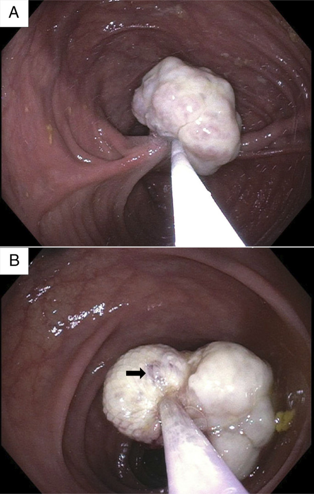 Pseudo-Pseudo Polyp: Spindle Cell Sarcoma at an Ileocolonic Anastomosis.