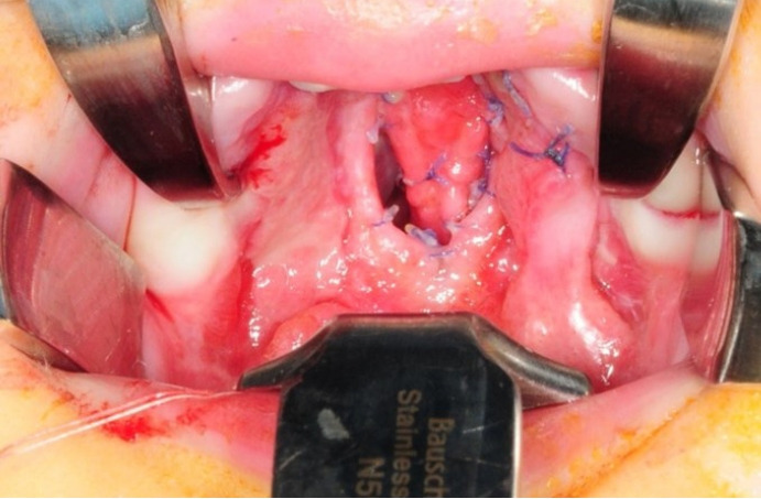 Familial predisposition to flap necrosis after palatoplasty: a case report of two siblings with bilateral cleft palate.