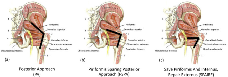 HIP Surgical Techniques to Enhance Rehabilitation (HIPSTER) : a single-centre, double-blind, parallel three-arm, randomized-controlled, superiority trial.