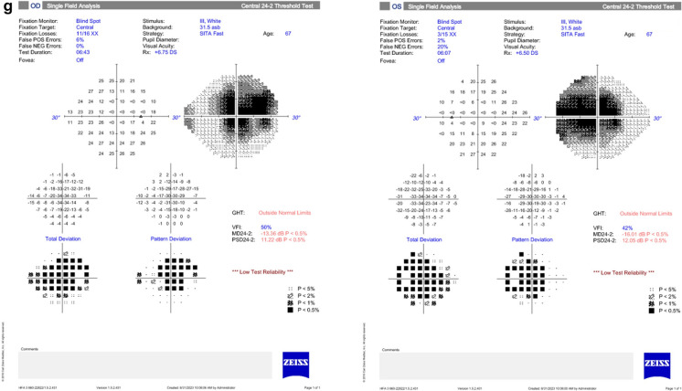 Diagnosis and treatment of autoimmune retinopathy: review of current approaches.