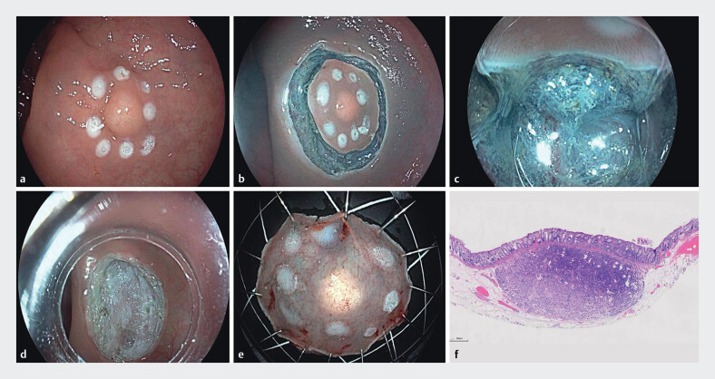 Efficacy of endoscopic intermuscular dissection vs. endoscopic submucosal dissection in treating rectal neuroendocrine tumors < 10 mm.