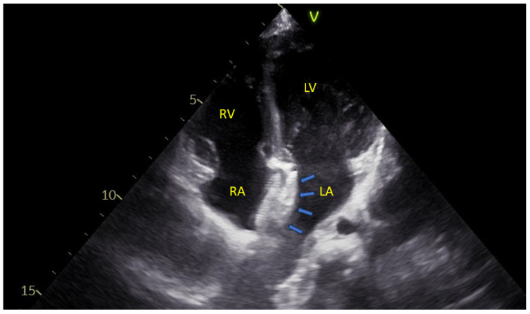 The Congenital Malformation of the Interatrial Septum-A Review of Its Development and Embryology with Clinical Implications.