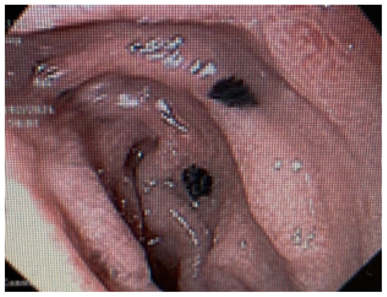 Disseminated Melanoma with Extensive Gastrointestinal Tract Involvement: Incidental Detection of Metastases on Upper Endoscopy.