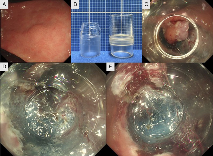 Usefulness of the Long Cap-Assisted Method for Securing Countertraction During Endoscopic Submucosal Dissection.