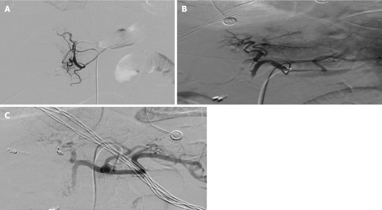 Vascular anomaly as a cause of late bleeding after endoscopic retrograde cholangiopancreatography: A case report.
