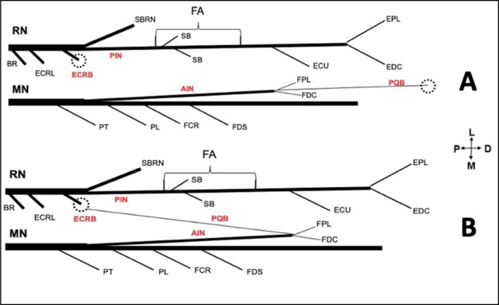 ANTERIOR INTEROSSEOUS NERVE TRANSFERS FOR THE TREATMENT OF RADIAL NERVE INJURIES.