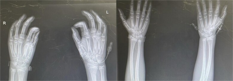 Precocious puberty in a rural Guatemalan boy: Unraveling the role of malnutrition and psychosocial stress.