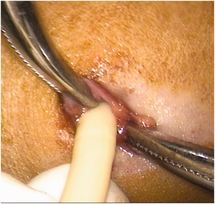 The balloon technique for trocar-site closure: Description of a novel technique along with a literature review.