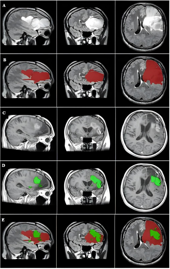 Correction: Preoperative FLAIR images for identifying glioblastoma boundaries.