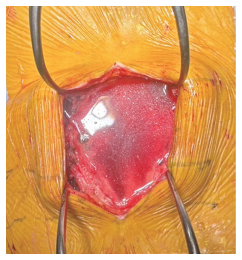 Comparison of topical and intravenous tranexamic acid for reducing postoperative blood loss in single-level posterior lumbar interbody fusion: a retrospective study from Japan.
