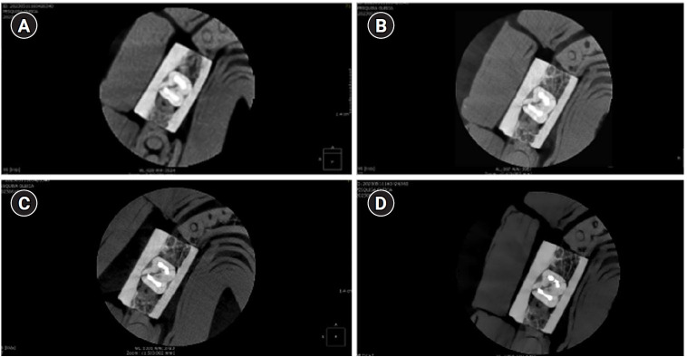 How protocol, posts, and experience affect fracture detection in multi-rooted teeth using cone-beam computed tomography: an ex vivo experimental study.