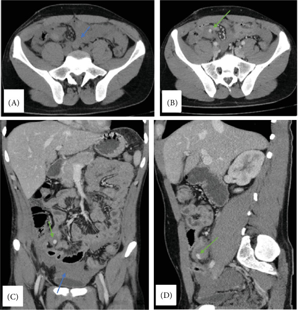 Unexpected Acute-Onset Stump Appendicitis in a Teenager: A Rare Postappendectomy Complication.