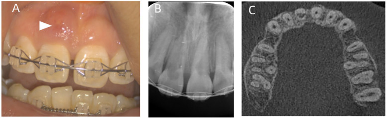 Rescuing a "hopeless" tooth with severe internal resorption during orthodontic therapy: a case report.