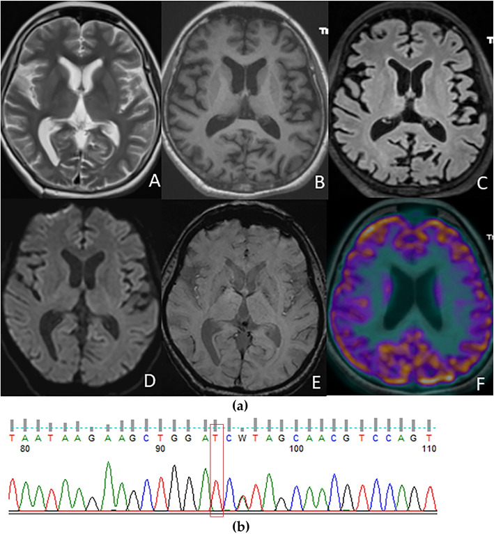 Clinical profile, atrophy and inheritance patterns of pathogenic MAPT gene mutations in Frontotemporal dementia detected using whole exome sequencing: a single-center first report from India.