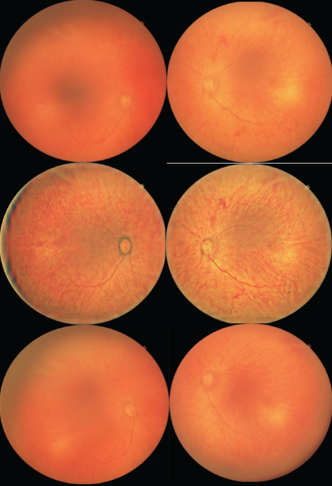 Effect of Ranibizumab in Patients with Treatment-Naïve Retinopathy of Prematurity.