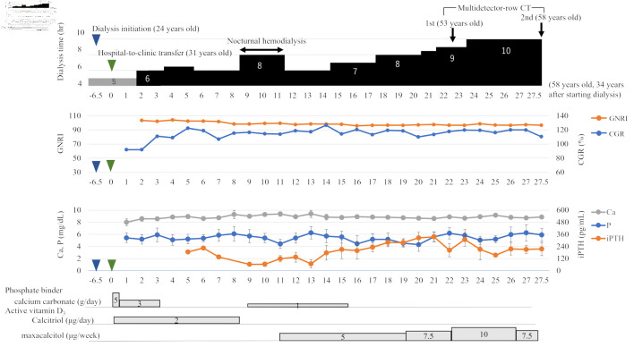Extended-Hours Hemodialysis Without Dietary Restrictions Reduces Risk of Vascular Calcification.