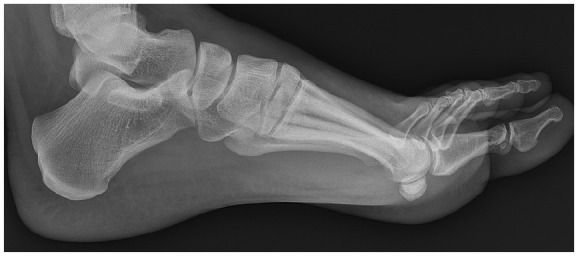Clinical Outcomes after ORIF vs Arthrodesis for Subtle Lisfranc Injuries: A Minimum 2-Year Comparative Study.